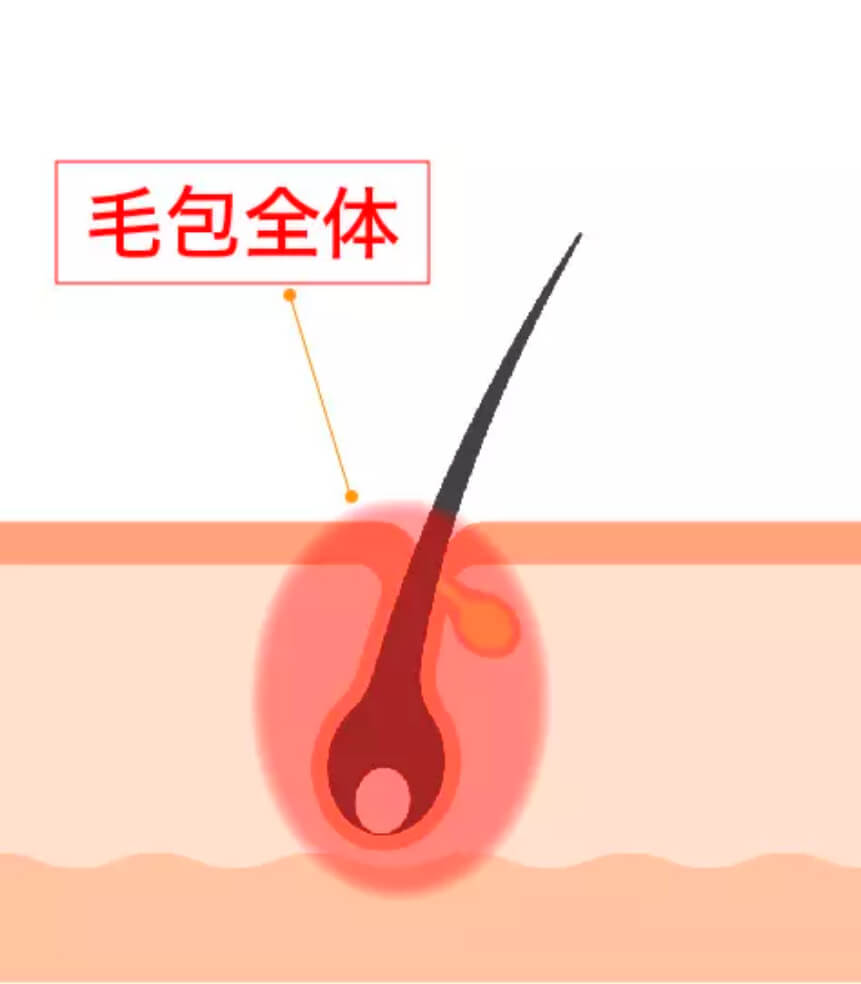 SHR脱毛機説明図